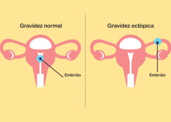 como identificar uma gravidez ectópica