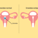 como identificar uma gravidez ectópica