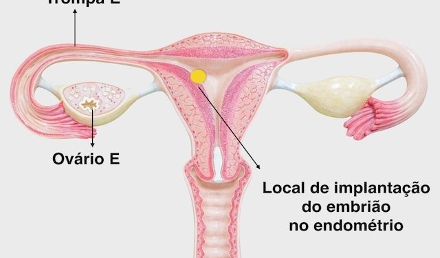 endométrio fino como tratar e ter a chance de engravidar