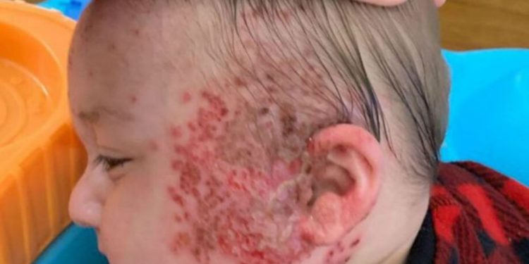 herpes em recém-nascidos entenda alerta de uma mãe