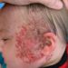 herpes em recém-nascidos entenda alerta de uma mãe