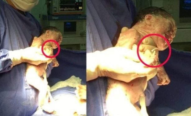 Nasceu agarrada ao DIU da mãe